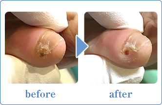 副爪施術写真