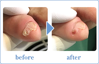 副爪・小指が痛い