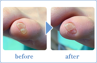 左足の小指の副爪