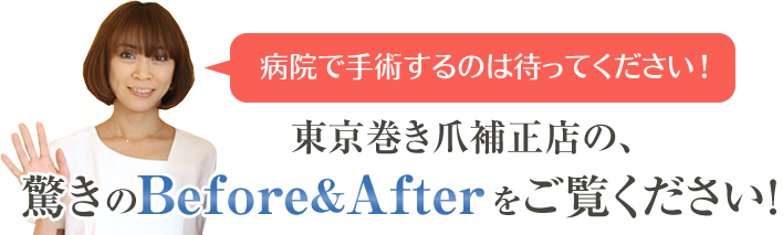 東京で巻き爪補正の驚きのビフォーアフターをご覧ください
