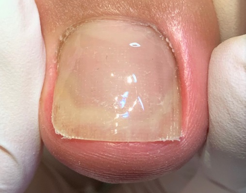 巻き爪　施術後