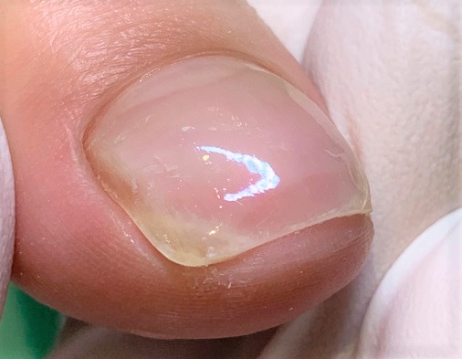 巻き爪　施術後