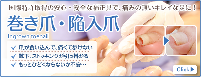 巻き爪・陥入爪