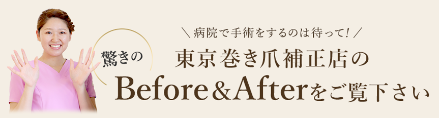 東京巻き爪補正店驚きのビフォーアフター