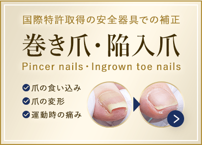 巻き爪・陥入爪