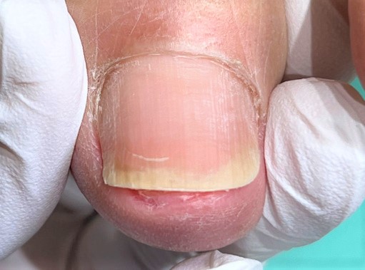 分厚い爪・変形爪・爪が伸びない施術後