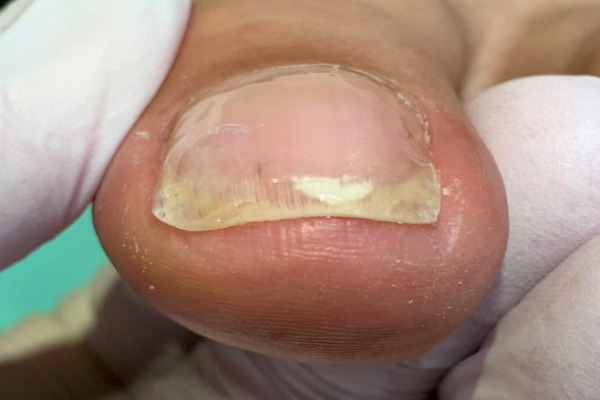 巻き爪　施術後