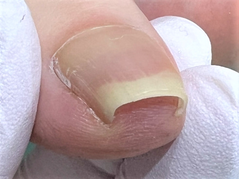 巻き爪　施術前