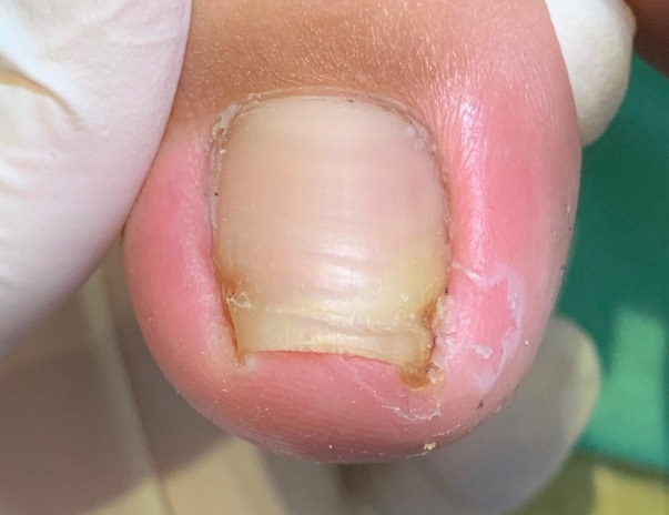 陥入爪ビフォー