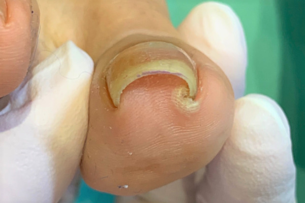 巻き爪　施術前