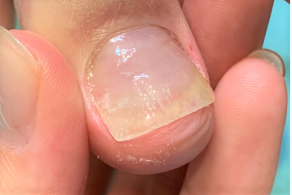 変形爪・分厚い爪・変色した爪アフター