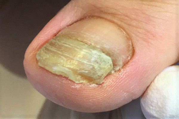 変形爪・分厚い爪・変色した爪ビフォー