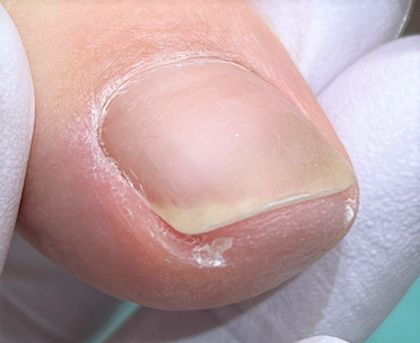 巻き爪　施術後