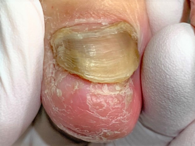 分厚い爪・変形爪・爪が伸びない