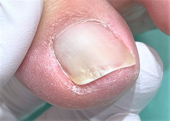 巻き爪　施術後