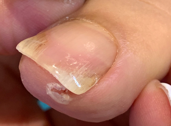 巻き爪　施術後