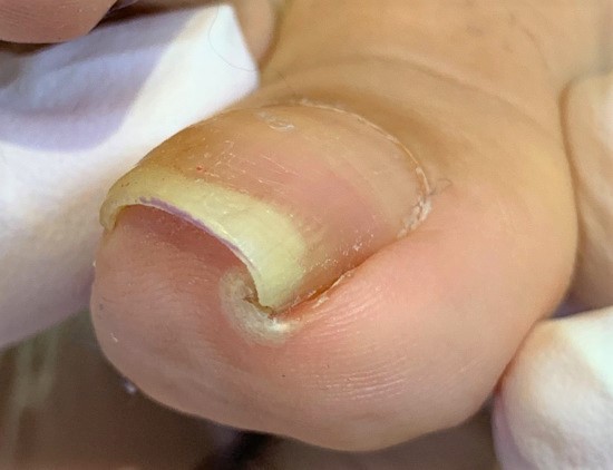 巻き爪　施術前