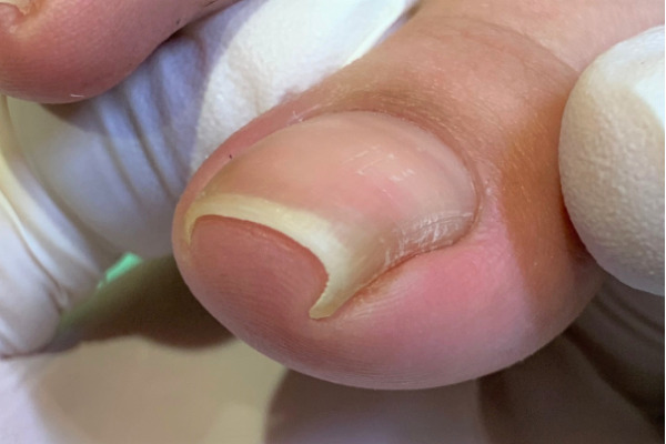 巻き爪　施術前