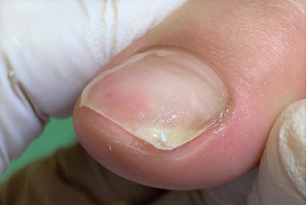 巻き爪　施術後