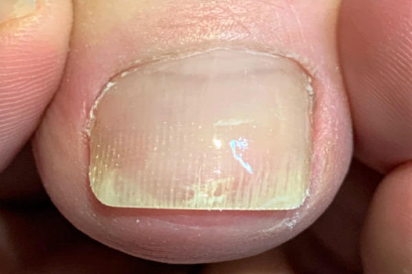 変形爪・分厚い爪・変色した爪施術後