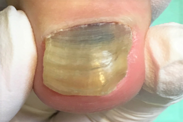 変形爪・分厚い爪・変色した爪