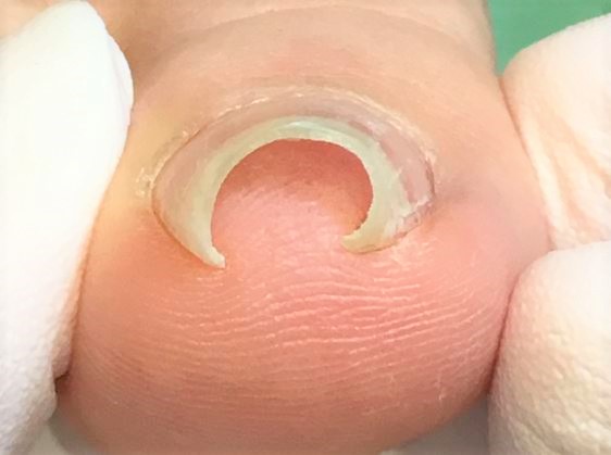 巻き爪　施術前