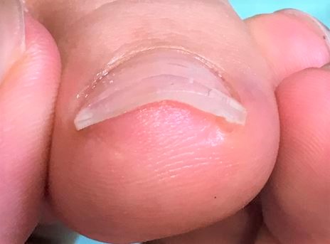 巻き爪　施術後