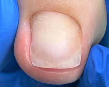 分厚い爪施術後