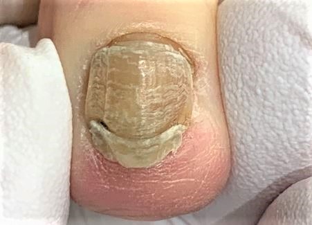 親指爪以外の巻き爪