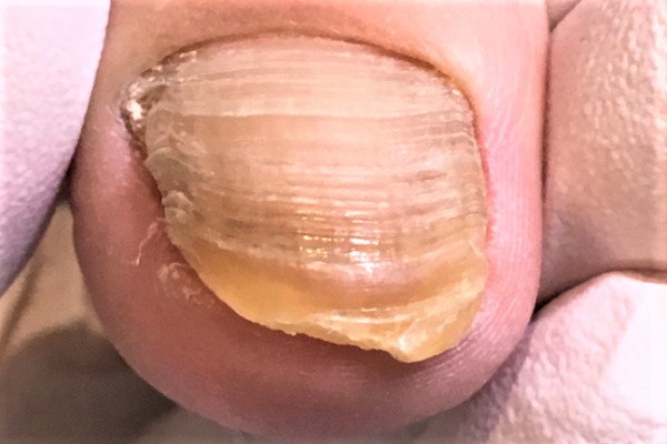 変形爪・ボコボコの爪・変色した爪