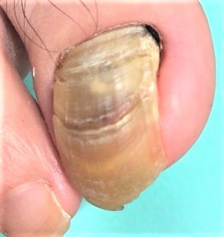 分厚い爪・変形爪・変色した爪