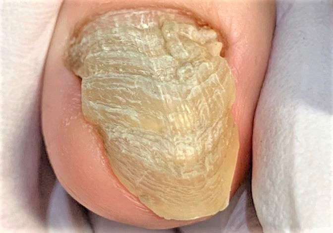 表面がガタガタの変形爪