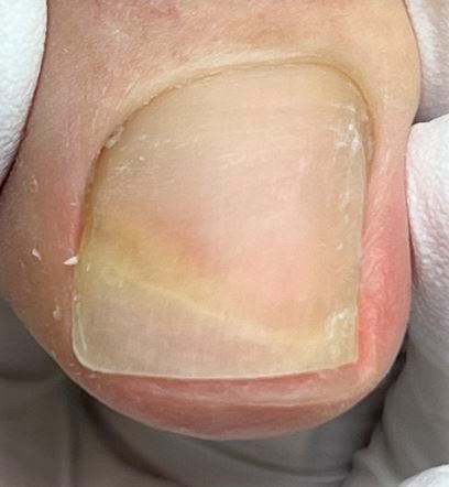 変形爪・分厚い爪・変色した爪施術後