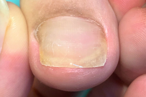 変形爪・ボコボコの爪・変色した爪施術後