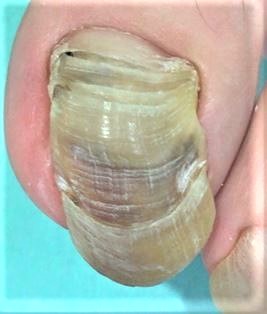 変形爪・分厚い爪・変色した爪・表面がガタガタの爪