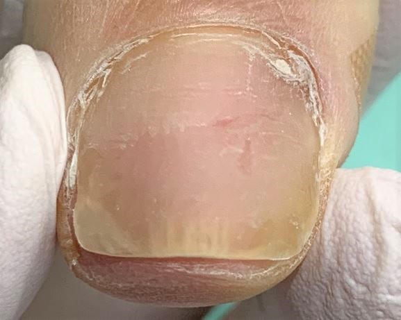 変形爪・変色した爪・爪が生えてこない施術後