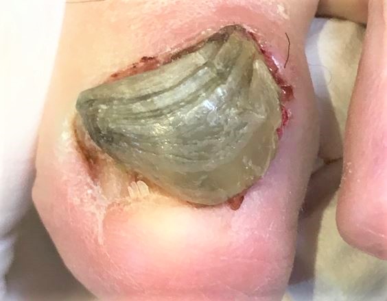 変色して分厚くなった爪