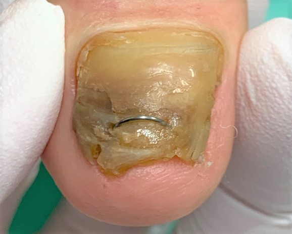 変形爪・分厚い爪・変色した爪