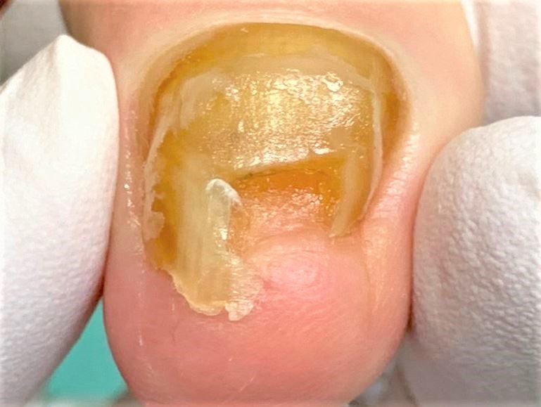 表面が割れた変形爪