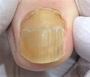 変色して分厚くなった爪
