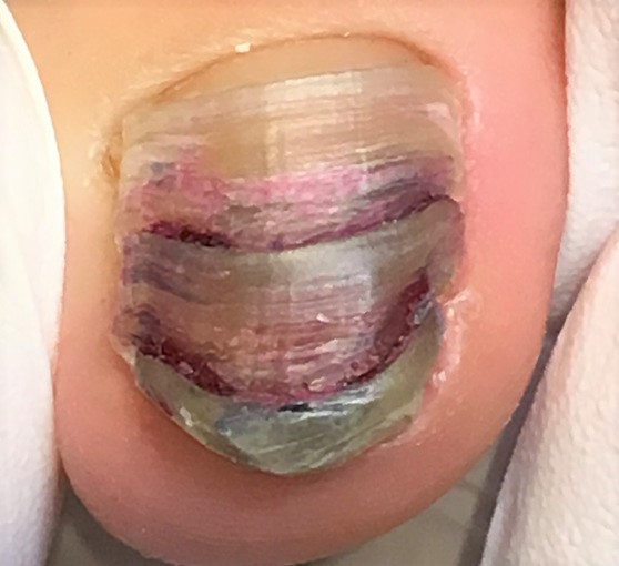 変形爪・ボコボコの爪・変色した爪