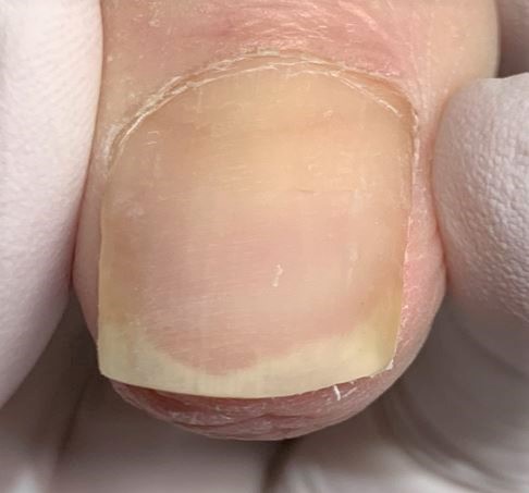 分厚い爪・変形爪・変色した爪施術後