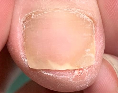 変形爪・変色した爪・分厚い爪施術後