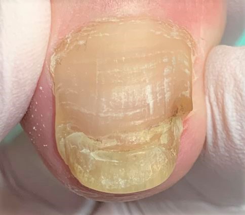 分厚い爪・変形爪・変色した爪