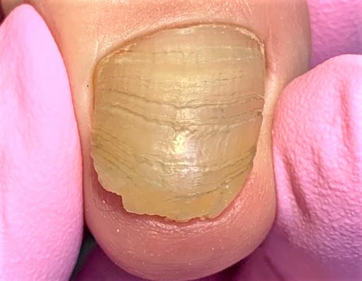 変形爪、ぼろぼろの爪