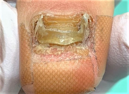 変形爪・爪が生えてこない