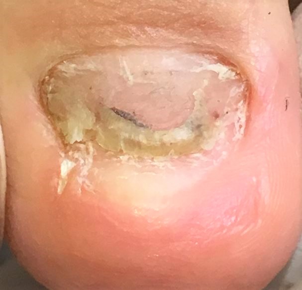 分厚い爪・変形爪・変色した爪・爪が伸びない