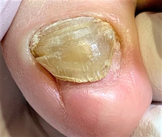 変形爪・変色した爪・分厚い爪