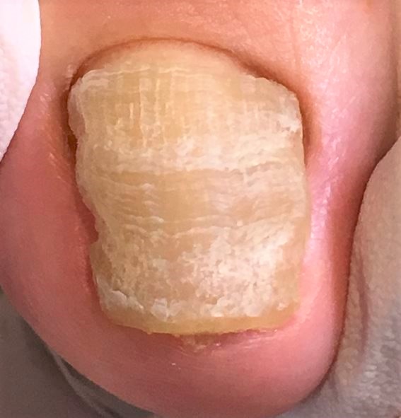 分厚い爪・変形爪・爪が伸びない・爪の表面がガタガタ