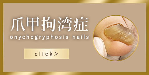 爪甲拘湾症